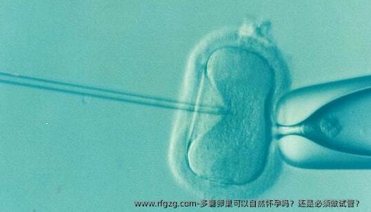 多囊卵巢可以自然怀孕吗？还是必须做试管？ 