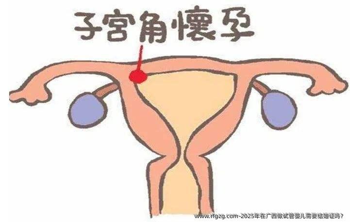 2025年在广西做代孕需要结婚证吗？