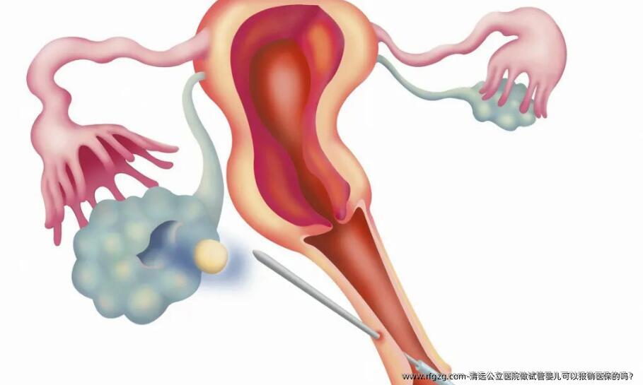 清远公立医院做代孕可以报销医保的吗？